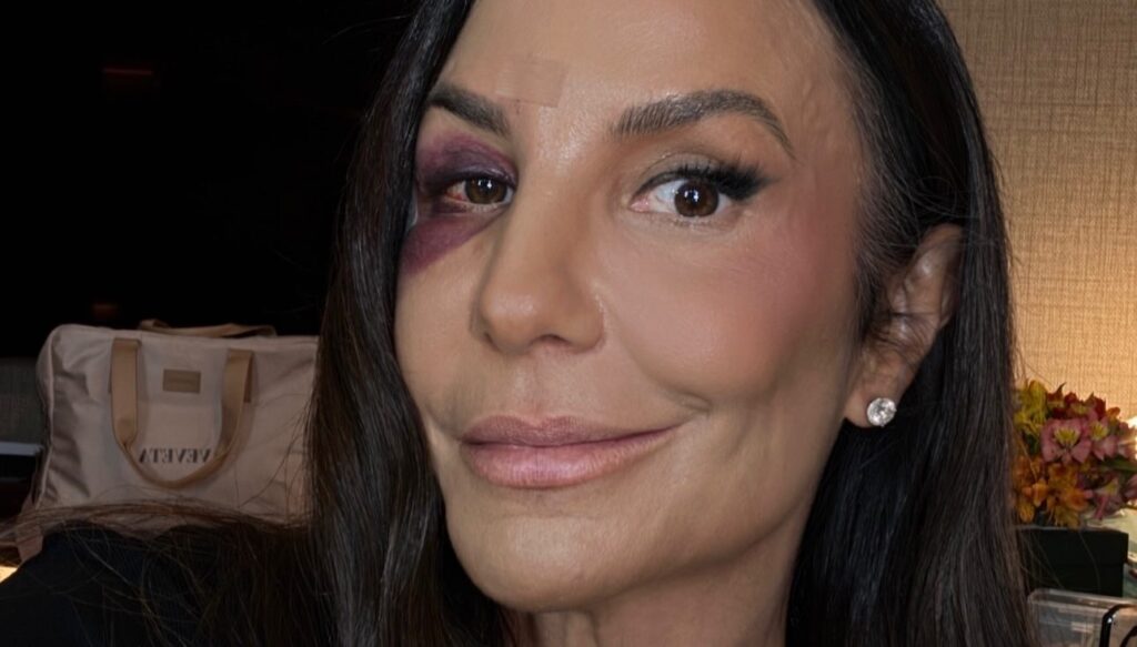 Ivete Sangalo dá detalhes de acidente doméstico em que fraturou ossos da face