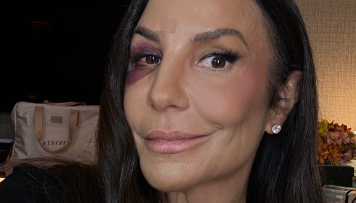 Ivete Sangalo dá detalhes de acidente doméstico em que fraturou ossos da face